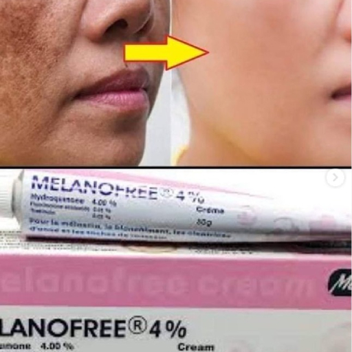 Melanofree Cream For Acne Scars Melanofree Cream For Acne Scars